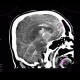 Intracranial aneurysm, subarachonid hemorrhage, hemocephalus: CT - Computed tomography